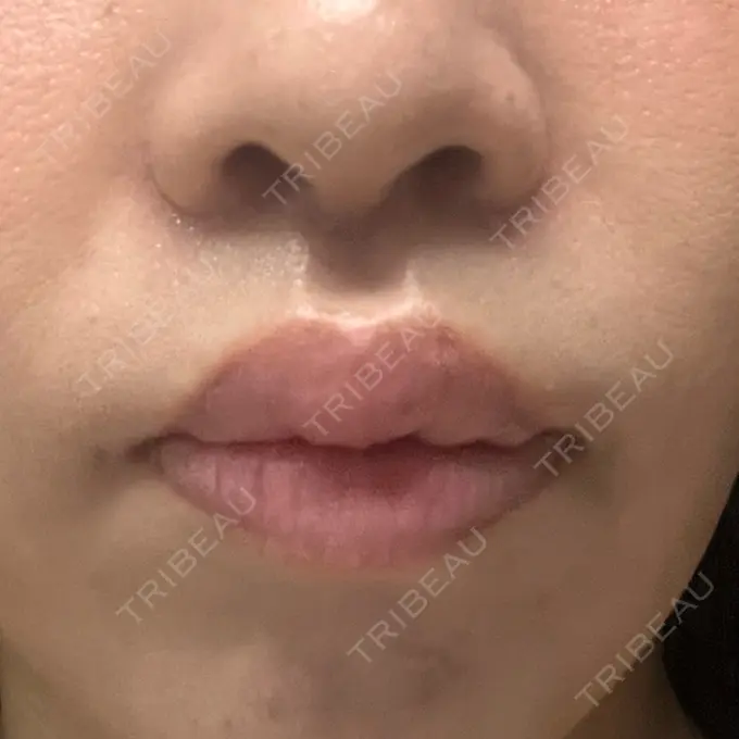 小鼻縮小（切開） / 人中短縮 / 鼻翼挙上 Otus Clinic 【オータスクリニック】 DAY 12 メイン用