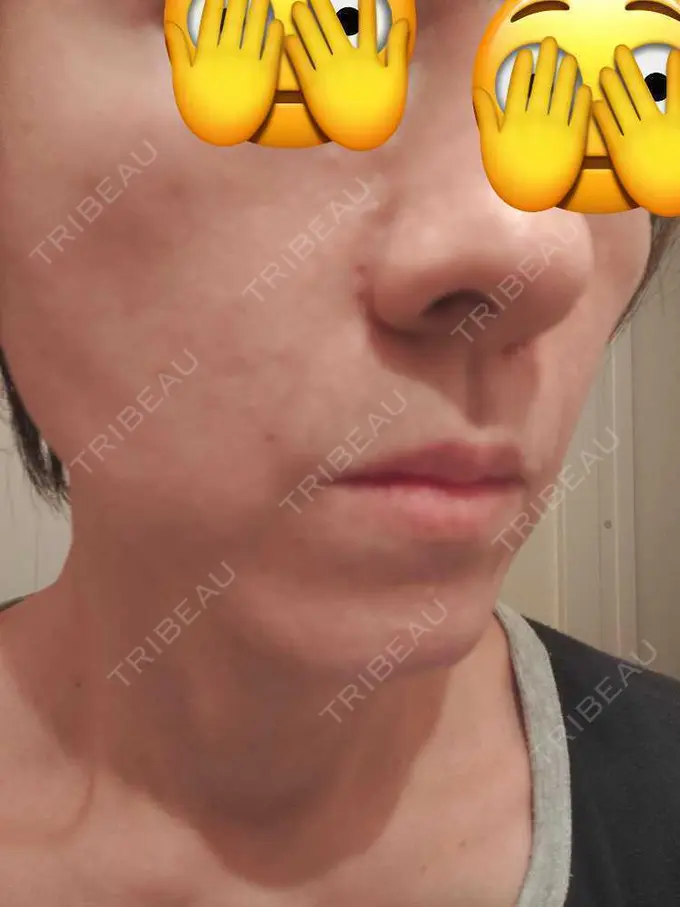 肌ヒアルロン酸注入（たるみ・シワ改善） / ルメッカ 豊洲内科・糖尿病 / 形成・美容外科クリニック DAY 0 メイン用