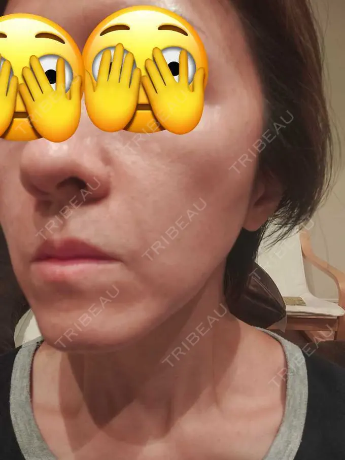 肌ヒアルロン酸注入（たるみ・シワ改善） / ルメッカ 豊洲内科・糖尿病 / 形成・美容外科クリニック DAY 0 メイン用