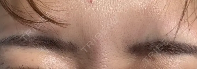 ボトックス（眉間） 湘南美容クリニック 博多院 DAY 8 メイン用