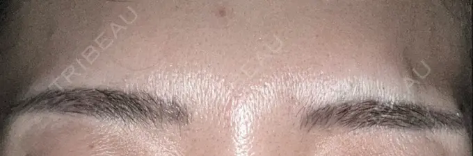 ボトックス（眉間） 湘南美容クリニック 博多院 DAY 9 メイン用