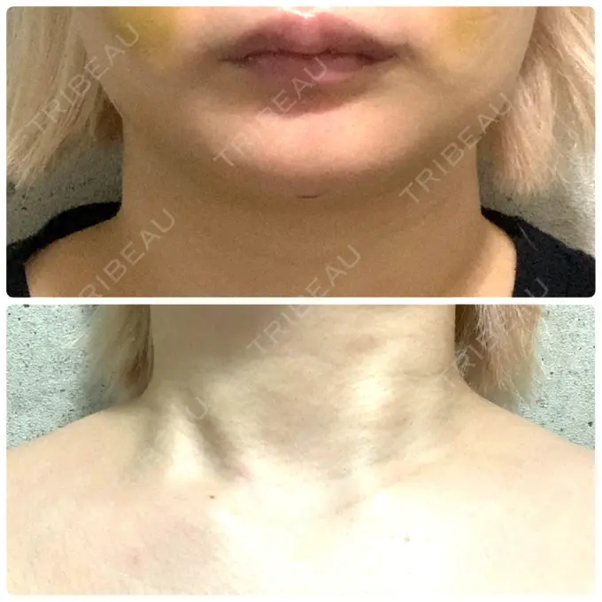 ボトックス（エラ・小顔） / ボトックス（肩） ルラ美容クリニック 上野院 DAY 8 メイン用