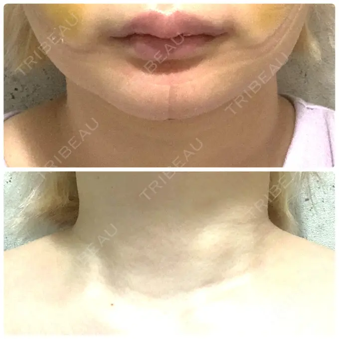 ボトックス（エラ・小顔） / ボトックス（肩） ルラ美容クリニック 上野院 DAY 10 メイン用