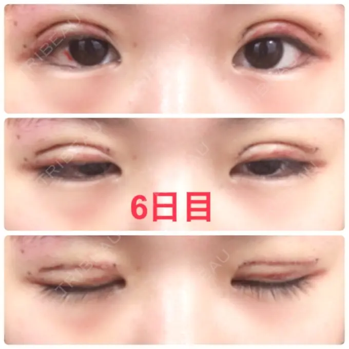 二重切開 品川スキンクリニック広島院 DAY 6 メイン用