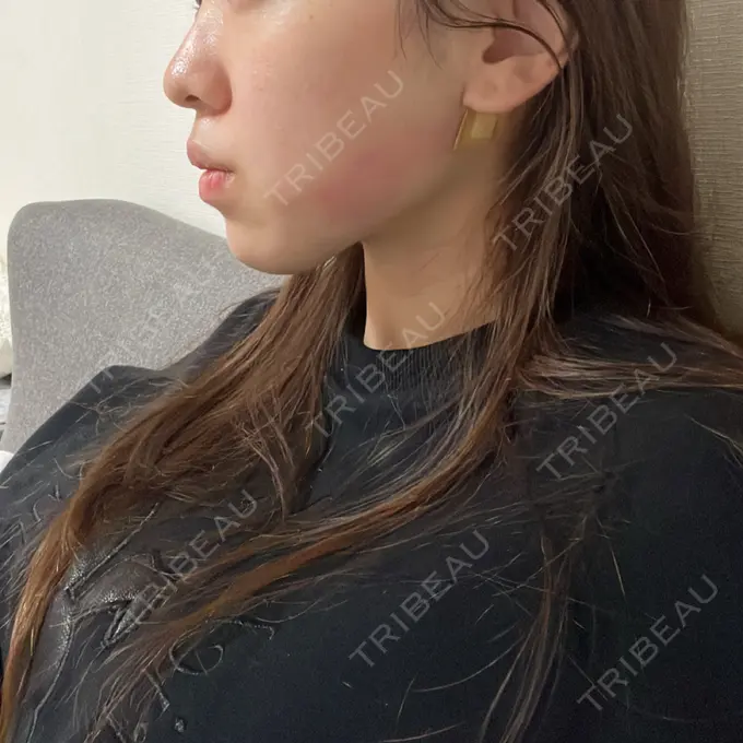 糸リフト / バッカルファット除去 / 脂肪吸引（顔） / ヒアルロン酸注入（あご） / ボトックス（エラ・小顔） RIVER CLINIC（リバークリニック） DAY 0 メイン用