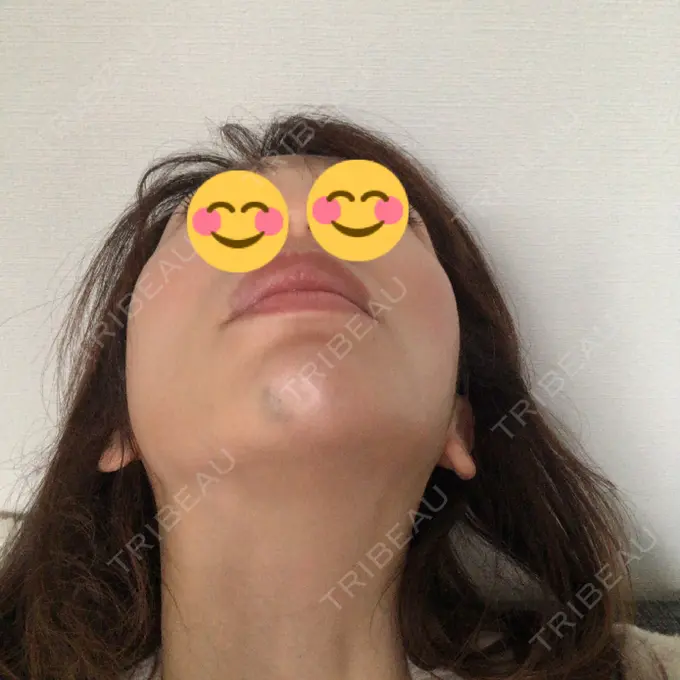 ボトックス（あご） TCB東京中央美容外科 柏院 AFTER メイン用