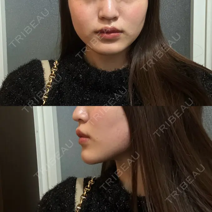 糸リフト / 脂肪吸引（顔） Casa de GRACIA GINZA 【カーサデグラシアギンザ】 AFTER メイン用