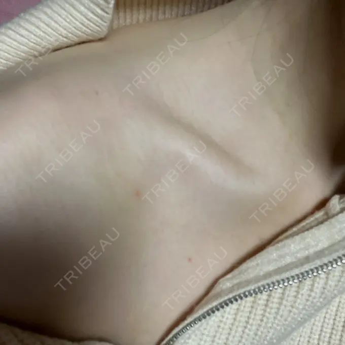 ボトックス（肩） L‘amour clinic Tokyo【ラムールクリニック東京】 DAY 2 メイン用