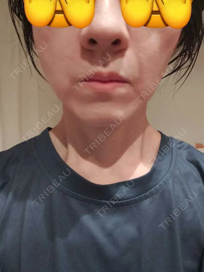 肌ヒアルロン酸注入（たるみ・シワ改善） / ルメッカ 豊洲内科・糖尿病 / 形成・美容外科クリニック DAY 1 メイン用