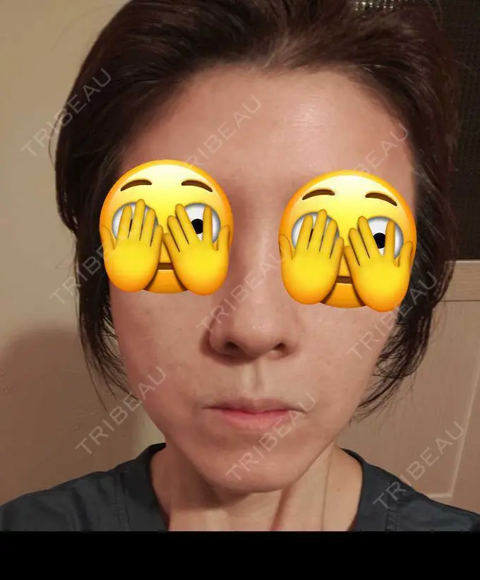 肌ヒアルロン酸注入（たるみ・シワ改善） / ルメッカ 豊洲内科・糖尿病 / 形成・美容外科クリニック DAY 2 メイン用