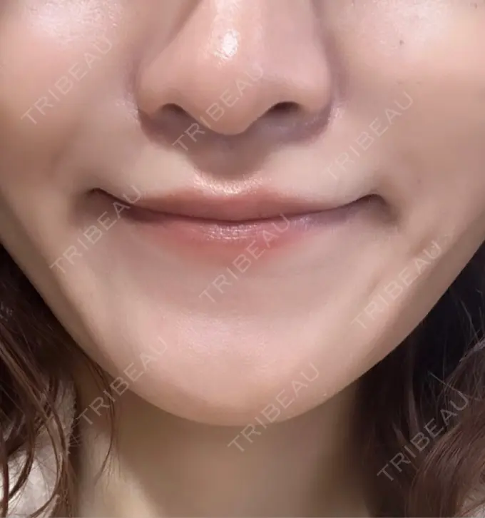 ヒアルロン酸注入（鼻翼基部） 豊洲内科・糖尿病 / 形成・美容外科クリニック AFTER メイン用