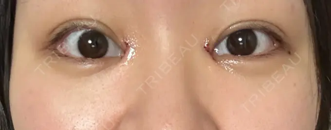 目頭切開 東京シンデレラ美容外科 池袋院 DAY 1 メイン用