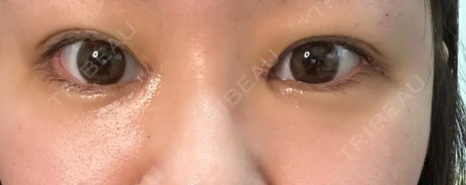 目頭切開 東京シンデレラ美容外科 池袋院 DAY 3 メイン用
