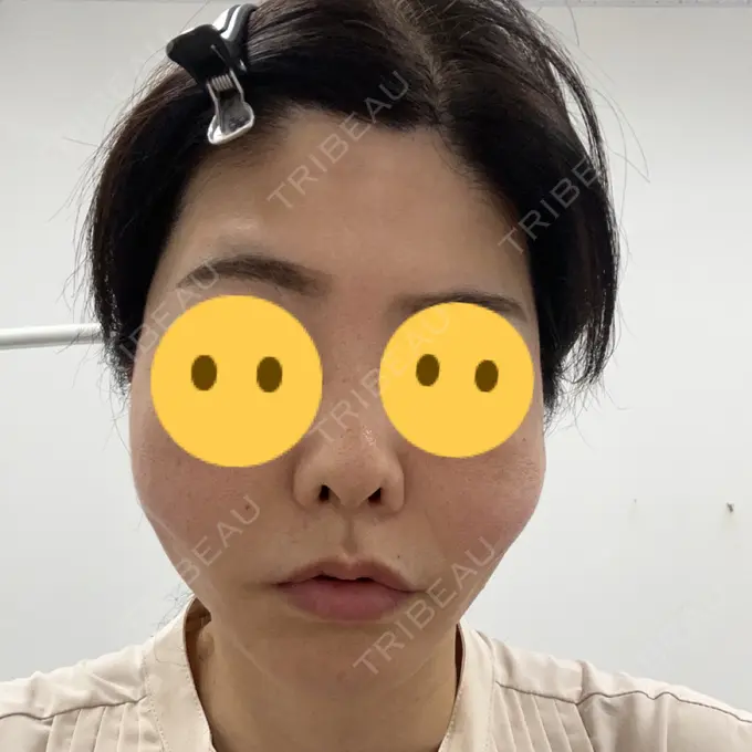 糸リフト TCB東京中央美容外科 柏院 AFTER メイン用