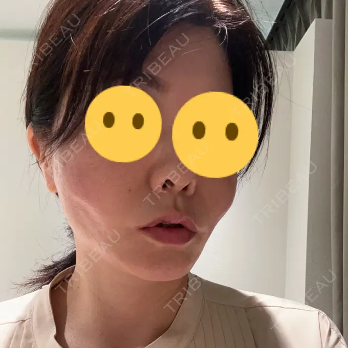 糸リフト TCB東京中央美容外科 柏院 DAY 0 メイン用