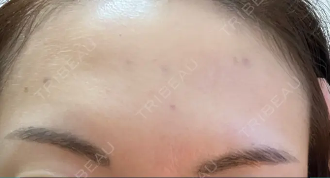 ボトックス（あご） / ボトックス（肩） / ボトックス（眉間） / ボトックス（額） M'sクリニック【エムズクリニック】 DAY 2 メイン用