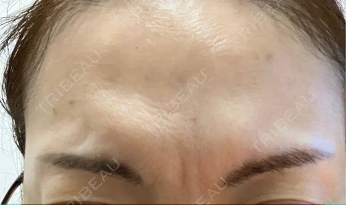 ボトックス（あご） / ボトックス（肩） / ボトックス（眉間） / ボトックス（額） M'sクリニック【エムズクリニック】 DAY 2 メイン用