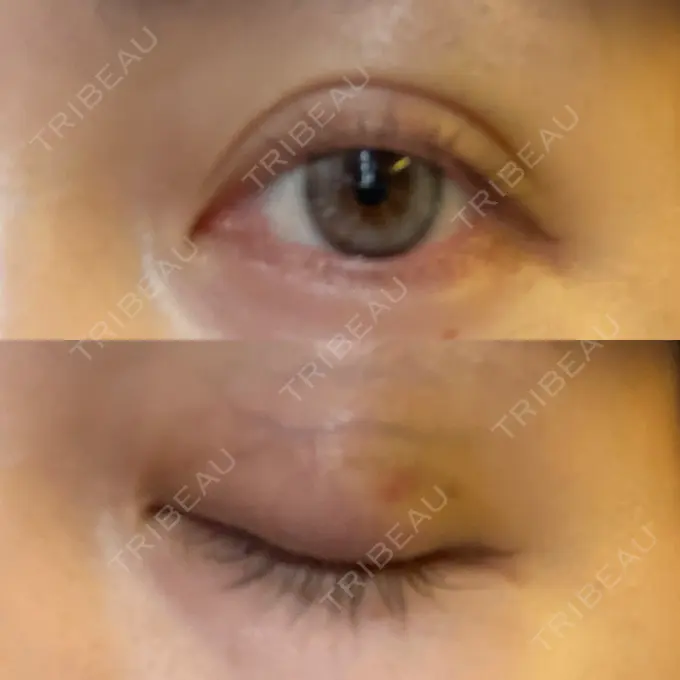 二重埋没 Brandnew Beauty Clinic DAY 3 メイン用