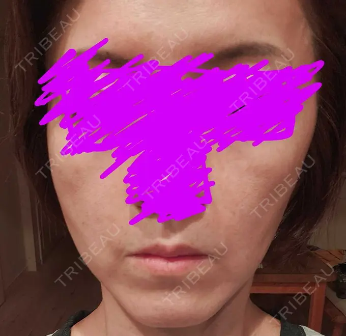 肌ヒアルロン酸注入（たるみ・シワ改善） / ルメッカ 豊洲内科・糖尿病 / 形成・美容外科クリニック AFTER メイン用