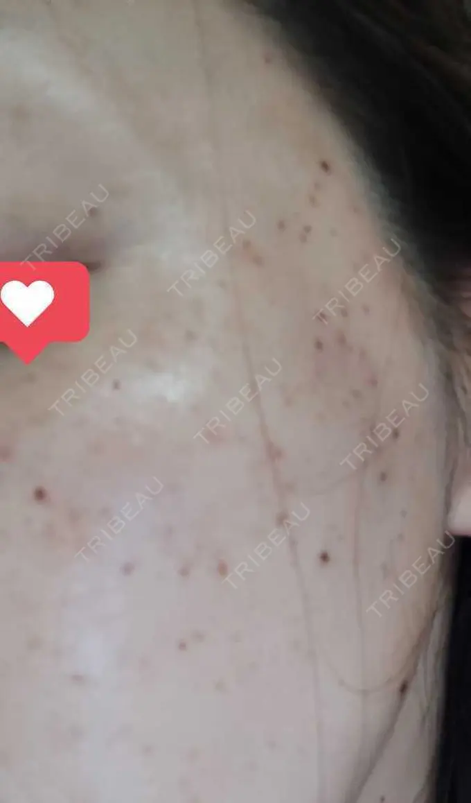 ルメッカ ルラ美容クリニック 渋谷本院 DAY 0 メイン用