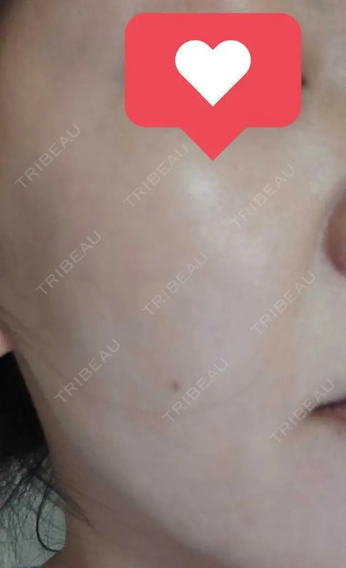 ルメッカ ルラ美容クリニック 渋谷本院 AFTER メイン用