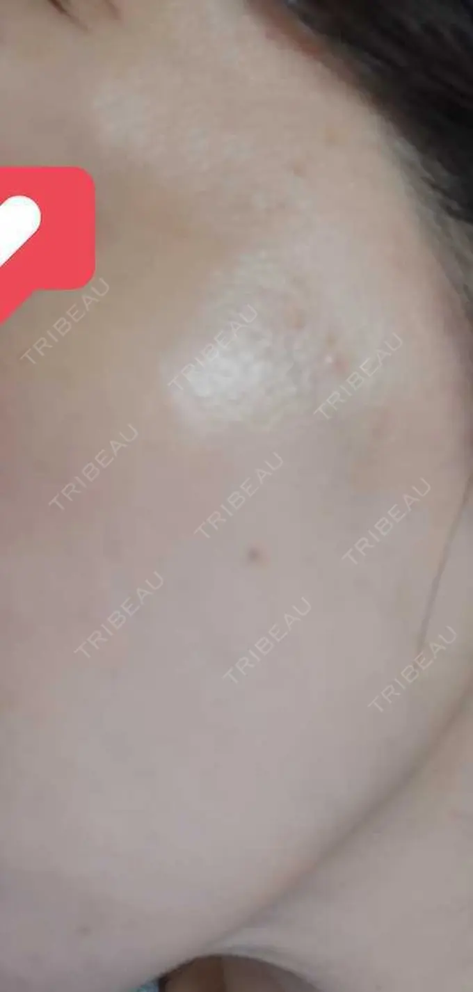 ルメッカ ルラ美容クリニック 渋谷本院 DAY 15 メイン用