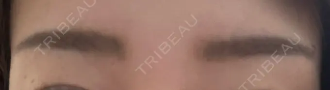 ボトックス（眉間） 湘南美容クリニック 博多院 DAY 10 メイン用