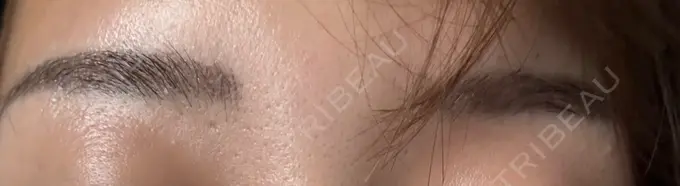 ボトックス（眉間） 湘南美容クリニック 博多院 AFTER メイン用