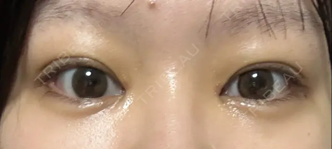 目頭切開 東京シンデレラ美容外科 池袋院 AFTER メイン用