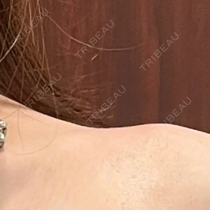 ボトックス（肩） L‘amour clinic Tokyo【ラムールクリニック東京】 DAY 4 メイン用