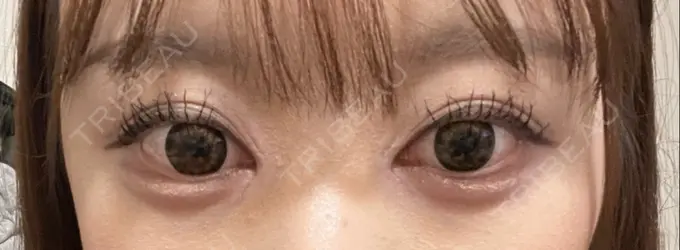 目頭切開 AI Beauty Clinic （エーアイ美容クリニック） DAY 5 メイン用