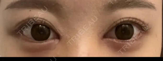 目頭切開 AI Beauty Clinic （エーアイ美容クリニック） DAY 6 メイン用