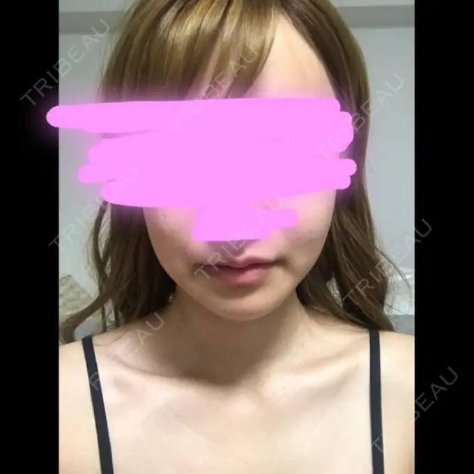 骨削り（エラ） / 骨削り（頬） / 目尻切開 / タレ目形成・グラマラスライン（切開） / 輪郭修正 / その他（輪郭） ウォンジン（Wonjin）整形外科 DAY 38 メイン用