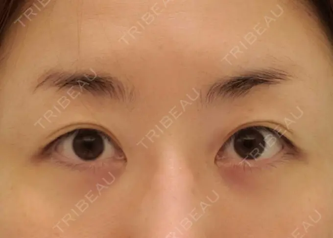 下まぶたたるみ取り / 下まぶたの脂肪取り / その他（目元） エースクリニック 名古屋院 AFTER メイン用