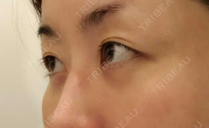 下まぶたたるみ取り / 下まぶたの脂肪取り / その他（目元） エースクリニック 名古屋院 DAY 55 メイン用