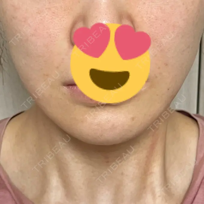 脂肪溶解注射（顔） X CLINIC 恵比寿院 DAY 26 メイン用