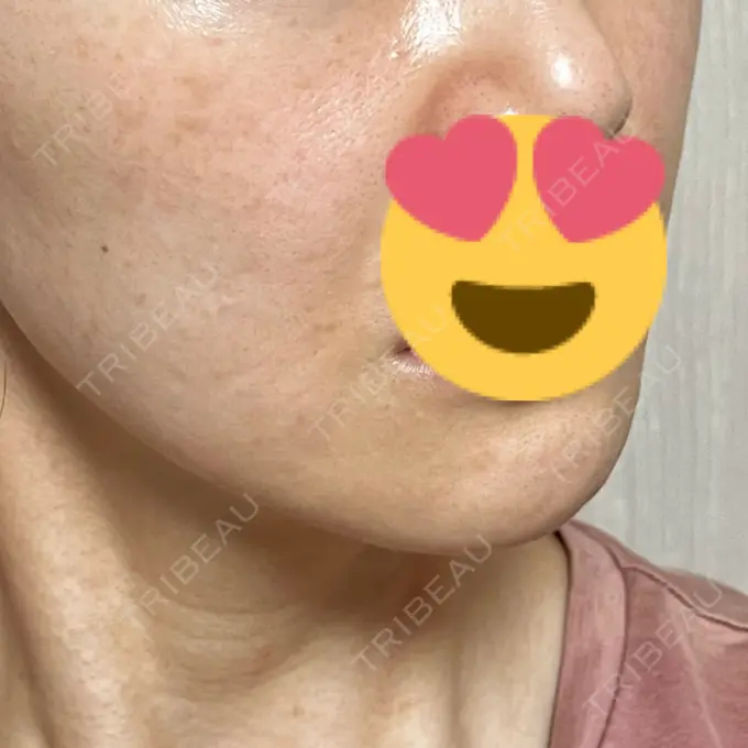 脂肪溶解注射（顔） X CLINIC 恵比寿院 DAY 26 メイン用