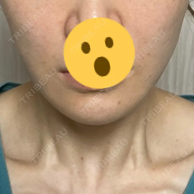 脂肪溶解注射（顔） X CLINIC 恵比寿院 DAY 31 メイン用