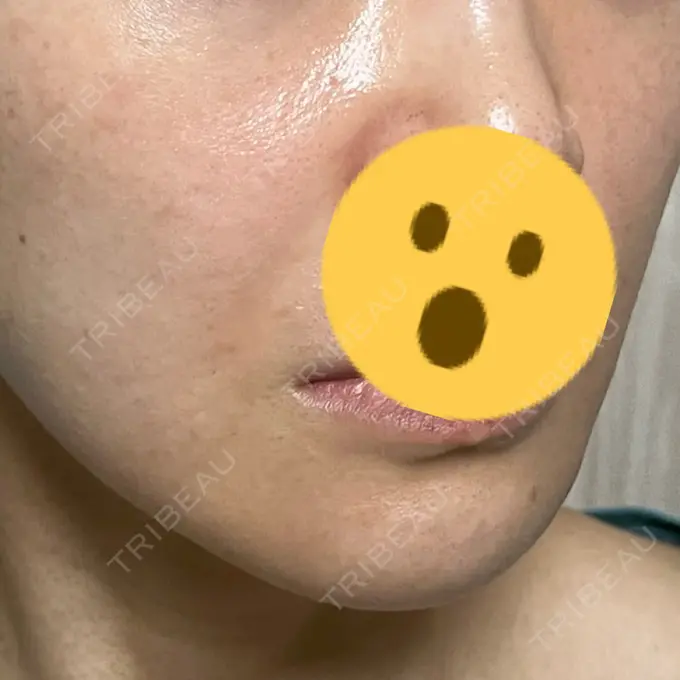 脂肪溶解注射（顔） X CLINIC 恵比寿院 DAY 31 メイン用