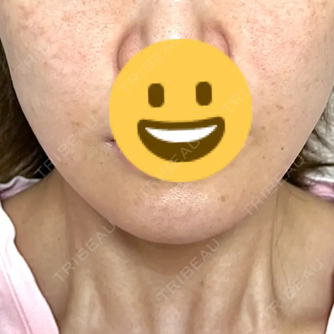 脂肪溶解注射（顔） X CLINIC 恵比寿院 DAY 55 メイン用