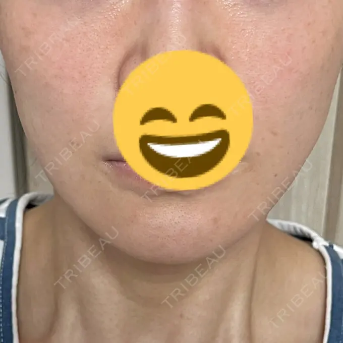 脂肪溶解注射（顔） X CLINIC 恵比寿院 AFTER メイン用