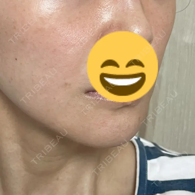 脂肪溶解注射（顔） X CLINIC 恵比寿院 DAY 66 メイン用