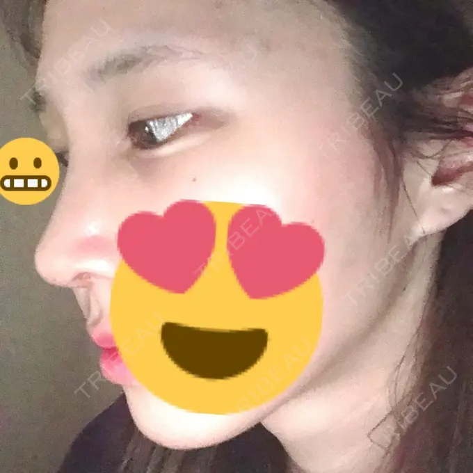 隆鼻術 / 鼻尖形成（切開） / 鼻中隔延長（切開） / 軟骨移植 / その他（鼻） FROM B整形外科 (旧バウム整形外科) DAY 14 メイン用