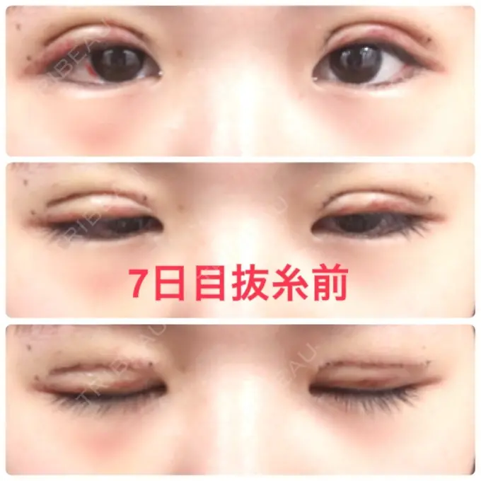 二重切開 品川スキンクリニック広島院 DAY 7 メイン用