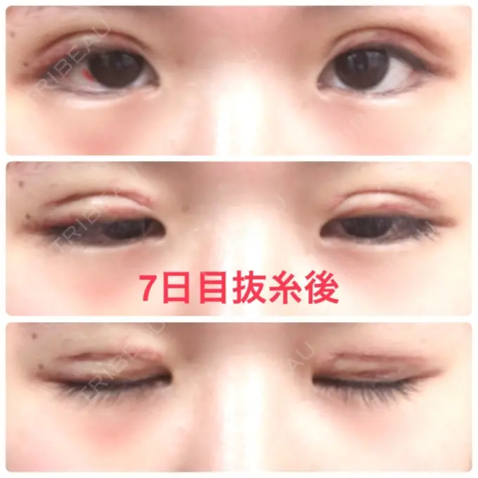 二重切開 品川スキンクリニック広島院 DAY 7 メイン用