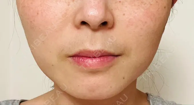 ボトックス（エラ・小顔） TCB東京中央美容外科 青森院 DAY 9 メイン用