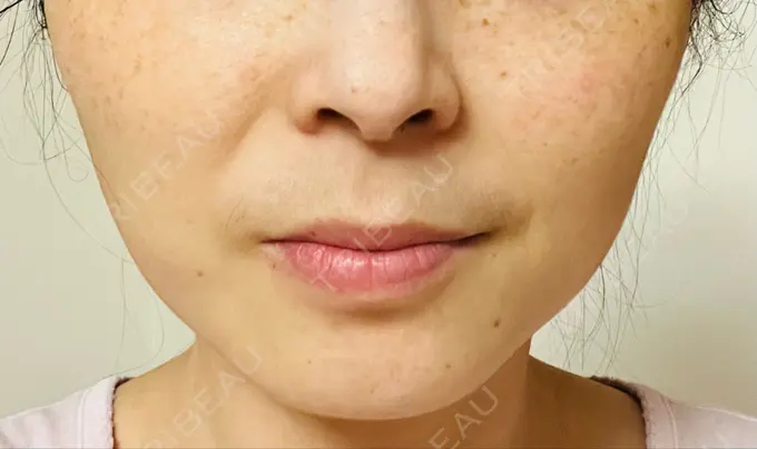 ボトックス（エラ・小顔） TCB東京中央美容外科 青森院 DAY 14 メイン用