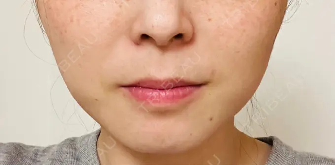 ボトックス（エラ・小顔） TCB東京中央美容外科 青森院 DAY 16 メイン用