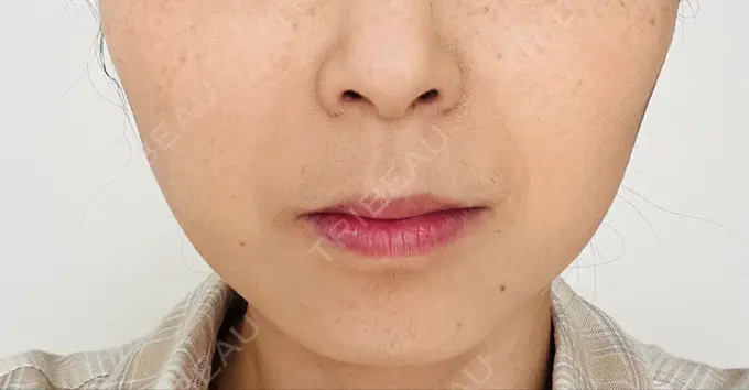 ボトックス（エラ・小顔） TCB東京中央美容外科 青森院 DAY 25 メイン用