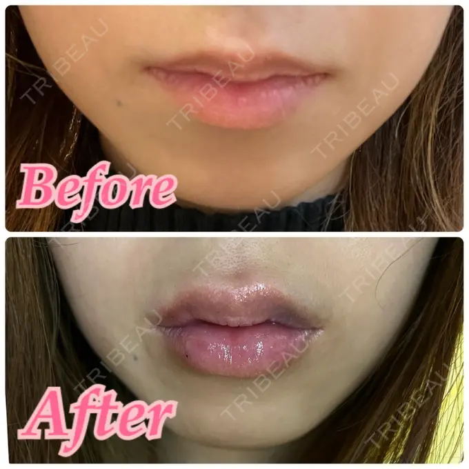 ヒアルロン酸注入（唇） 渋谷美容外科クリニック 新橋院 DAY 0 メイン用